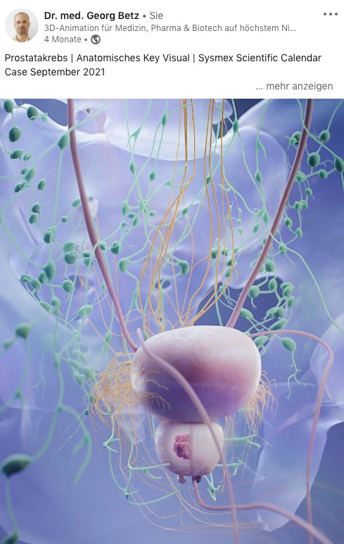Prostate cancer