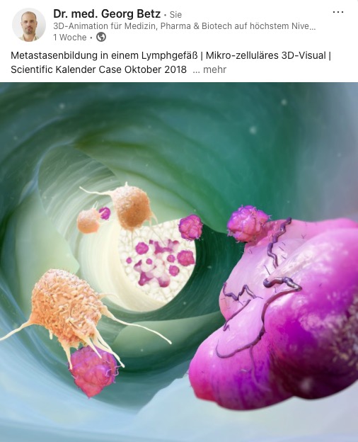Metastasenbildung in einem Lymphgefäß
