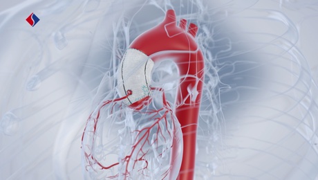Chirurgie der Aorta