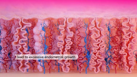 Heavy Menstrual Bleeding
