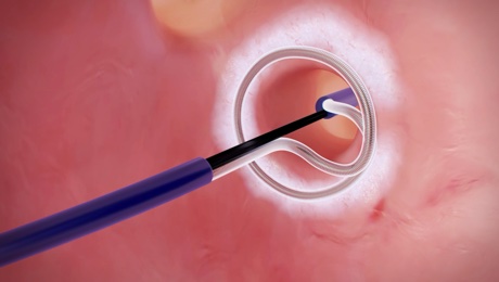 Cryoablation Heart