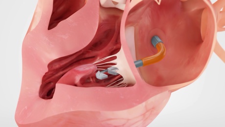 Mitral Valve Catheter