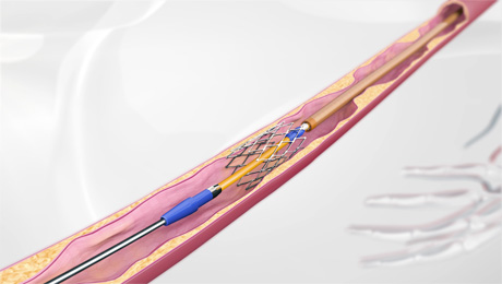 Vascular spot stenting