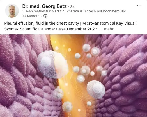 Medical Animation Pleuraerguss bei NTM-Lungeninfektion Medical Animation Pleuraerguss bei NTM-Lungeninfektion