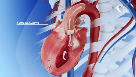 Aortic valve replacement