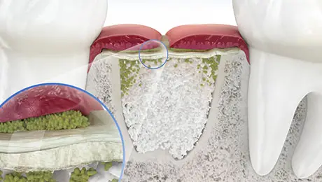 Bone membrane Bone membrane
