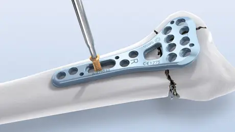 Surgical technique Surgical technique