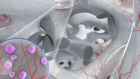 Bone regeneration Bone regeneration