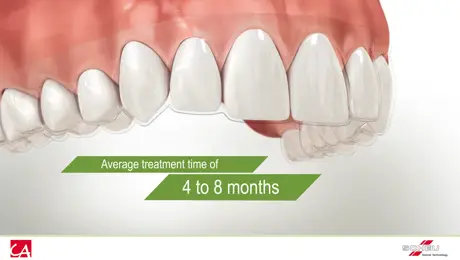 Tooth splint Tooth splint