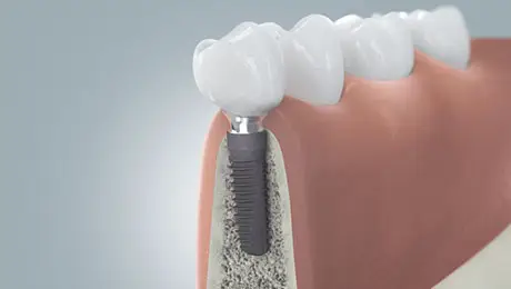 Dental illustrations Dental illustrations